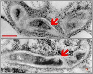 phagocytosed Nocardia (Actinomycetales) … cerebellar absces